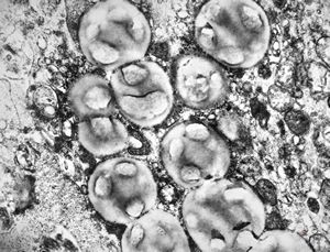 F, 45y. | necrobiosis lipoidica